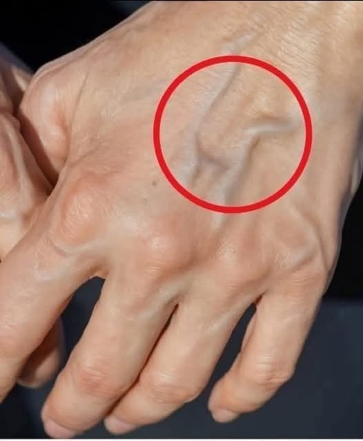 When to Be Concerned About Suddenly Visible Veins