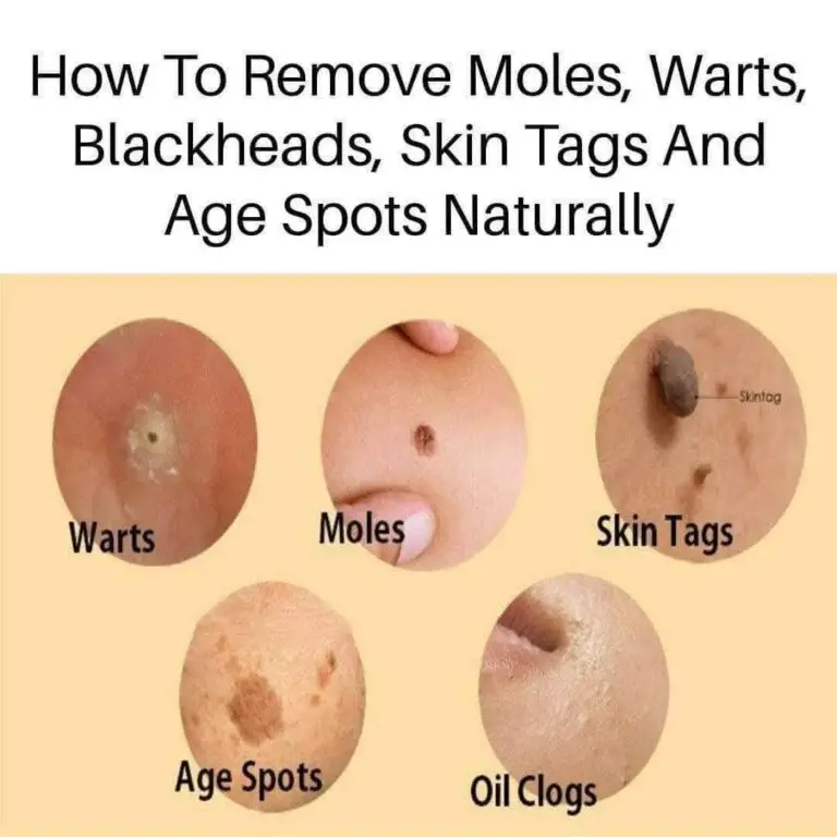 Natural Remedies for Age Spots, Moles, Skin Tags, Warts & Blackheads: Stress-Free, Budget-Friendly Tips + Monetization Hacks!