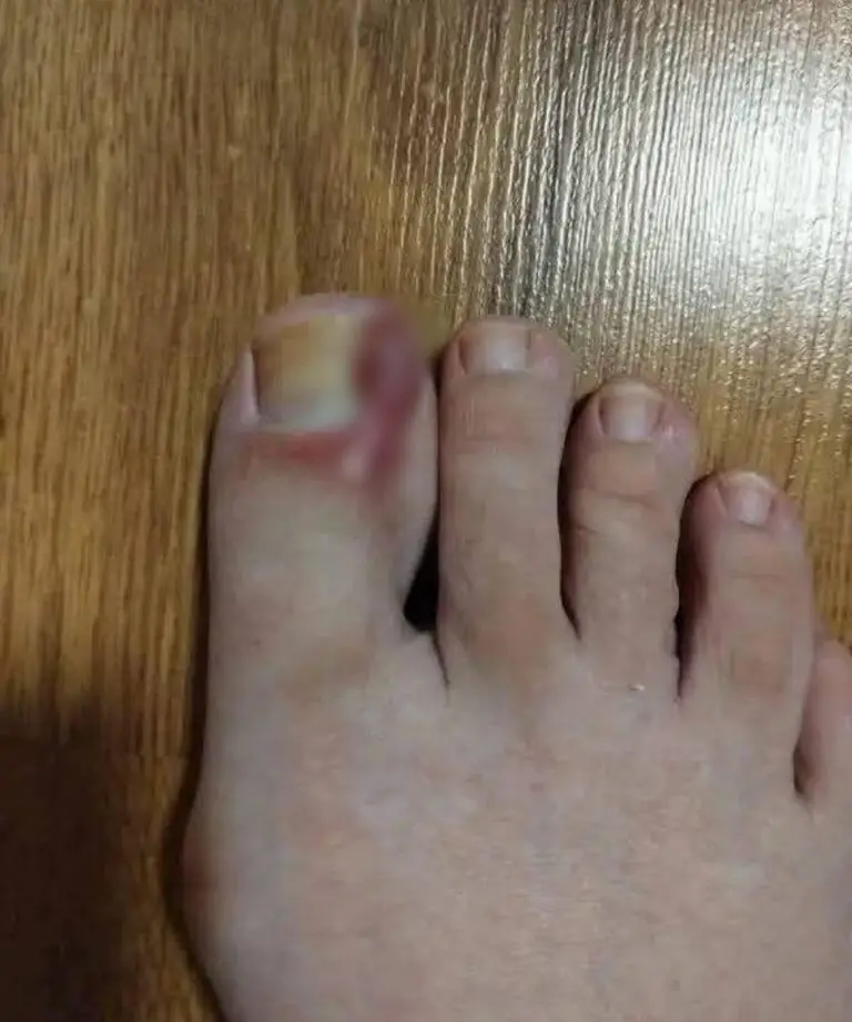 How to Treat an Ingrown Toenail at Home: A Step-by-Step Guide