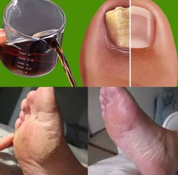 Solve Nail Fungi 100% Naturally: Healthy and Shiny Nails with Vinegar ✨