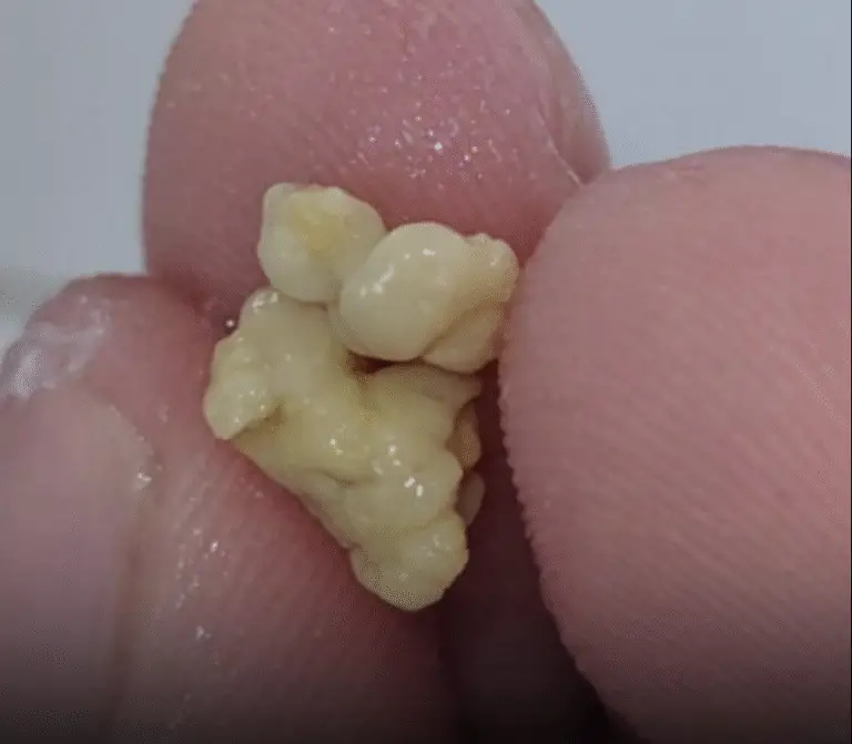 Here’s What You Need to Know About Tonsil Stones (Science, Causes, and What Actually Helps)