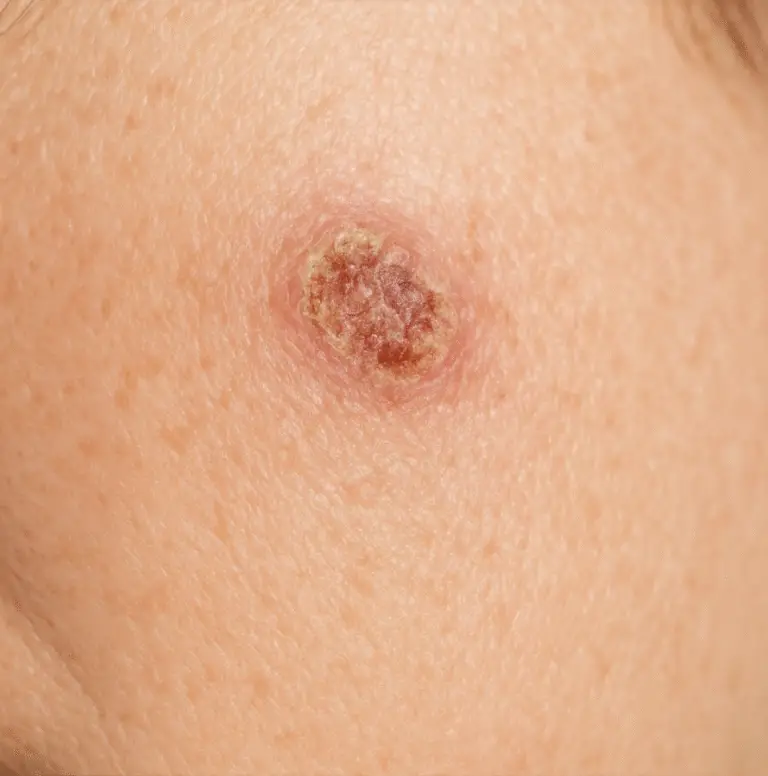 The Crusty Spot That Won’t Heal: What Your Skin May Be Trying to Tell You
